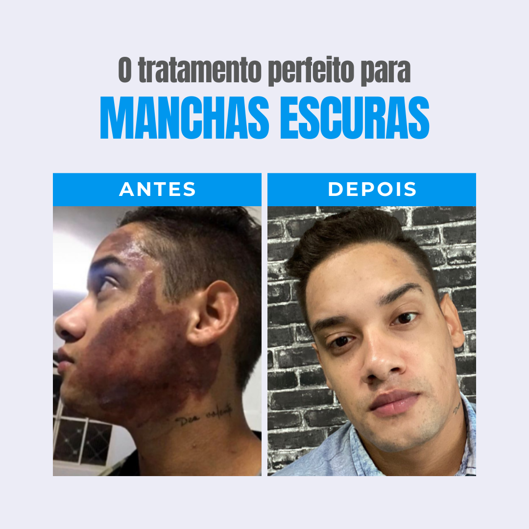 Kit 3 clareadores - Protocolo 90 dias