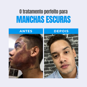 Kit 3 clareadores - Protocolo 90 dias